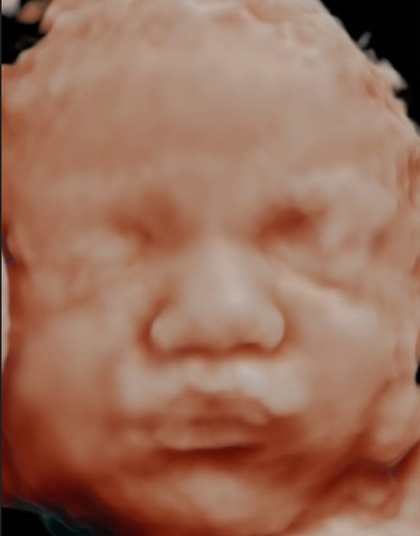 Ecografía original del rostro del bebé, comparativa principal